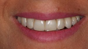 Puedo cerrar los espacios oscuros que tengo entre los dientes
