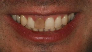 Tengo un diente oscuro ¿cómo puedo arreglarlo? - Clínica Bio - Odontología
