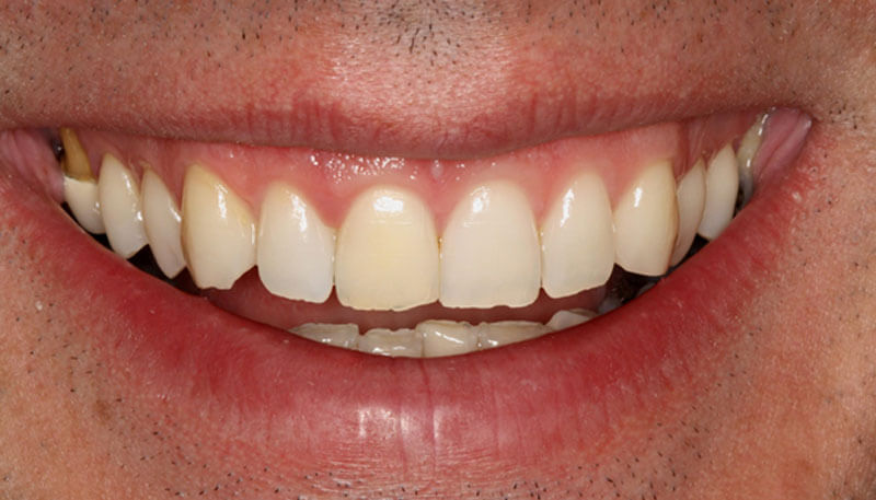 Tengo un diente oscuro ¿cómo puedo arreglarlo? - Clínica Bio - Odontología